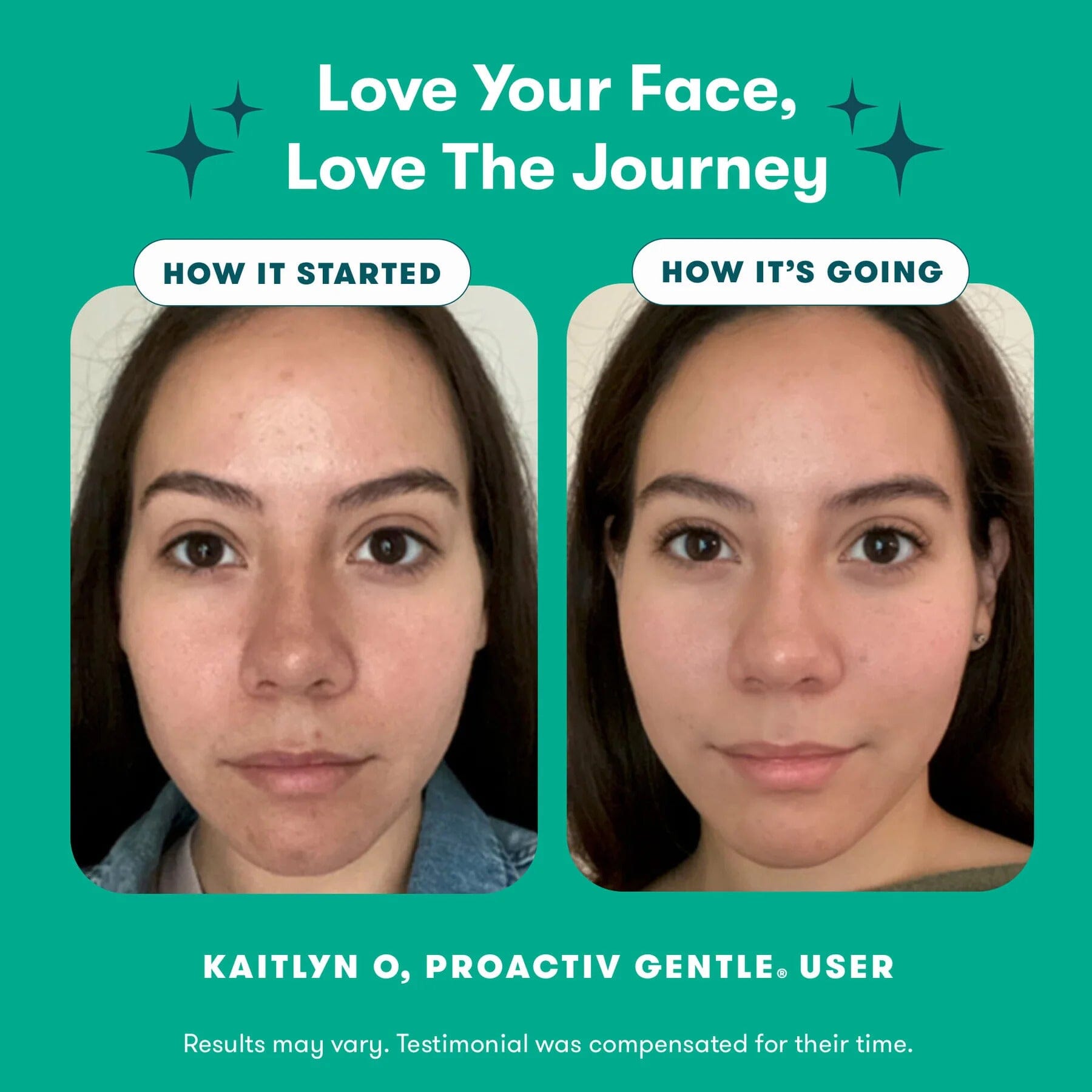 Proactive Gentle 3 step Acne Routine Kit Simple KojicLux 